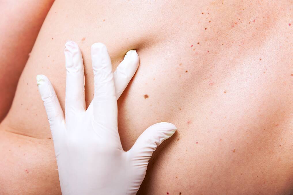 CHECK: Any changes to the skin are best to have checked out by a professional. Australian Skin Cancer Clinics conduct thorough skin checks by qualified Doctors.
