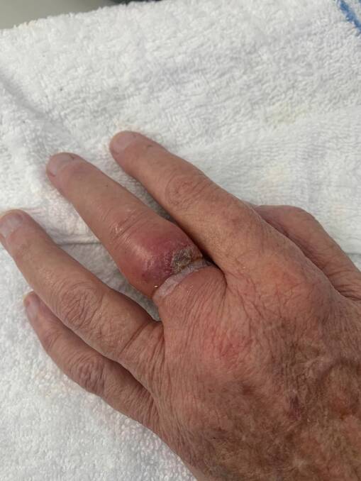 An elderly lady's hand after Cessnock District Rescue Squad removed her ring. Picture supplied.