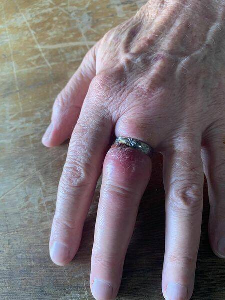 An elderly lady's hand before Cessnock District Rescue Squad removed the ring. Picture supplied.