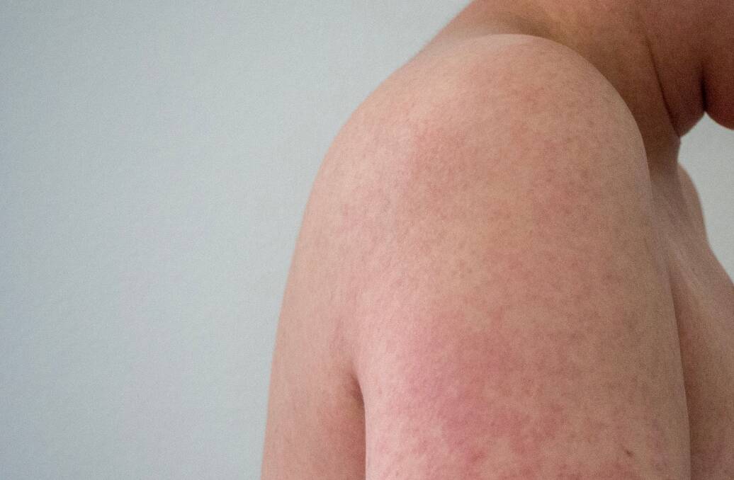 An example of the rash a person suffering from measles can contract. Picture: Shutterstock

