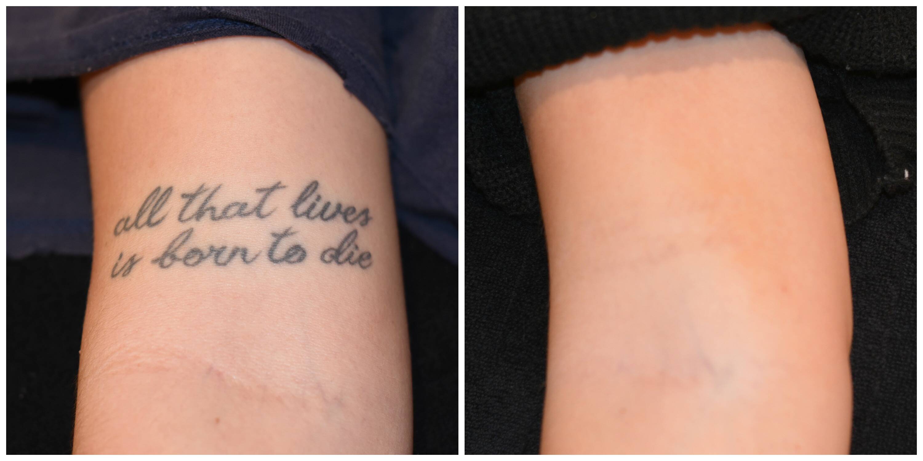 Laser tattoo removal | Lasers | Ramsay Health Care UK