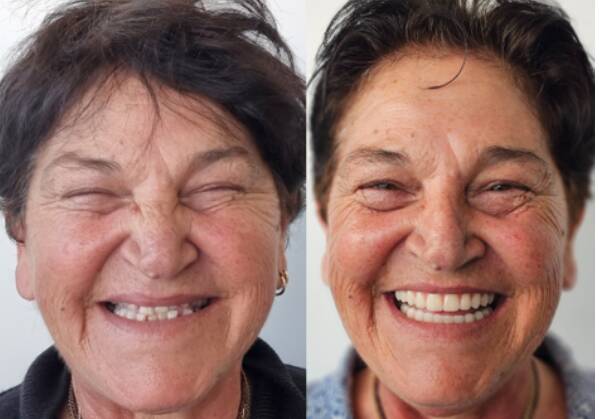 One of Affordable Implants and Dentures's patients Maria before and after having dental implants. Picture Affordable Implants and Dentures 