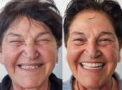 One of Affordable Implants and Dentures's patients Maria before and after having dental implants. Picture Affordable Implants and Dentures 